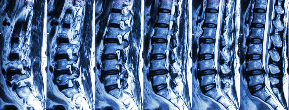 Bulging or herniated disc