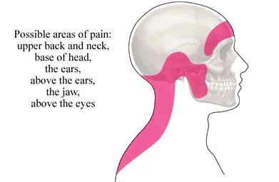 Illustration of where cervicogenic headache pain can radiate — upper back and neck, base of the head, the ears, the jaw, and above the eyes