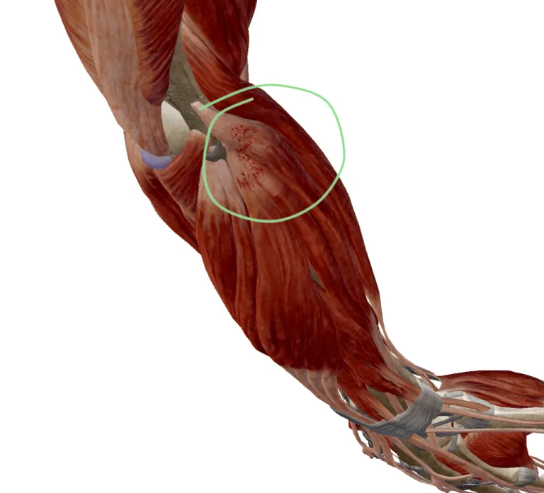Can Tennis Elbow Cause Shoulder or Neck Pain?